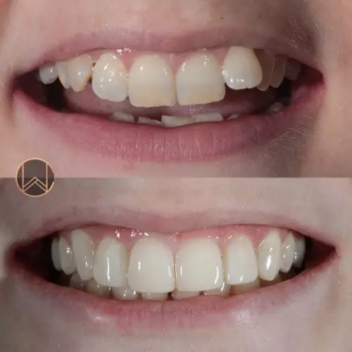 Invisalign & Bonding
