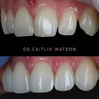 6 teeth partial coverage layered composites 😝 we are super super busy over the next few weeks and the hardest part is managing the diary to fit you all to get the composite done. We need a minimum of 6 weeks from initial consultation to composite bonding visit (if the bite is perfect and you don’t need Invisalign first 😅)