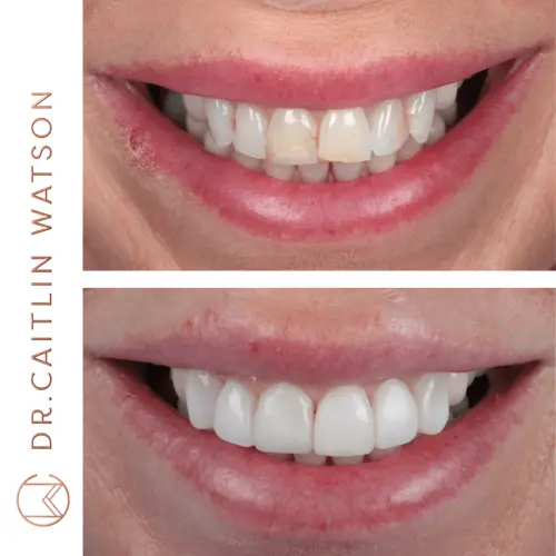 Whitening & Composite Bonding