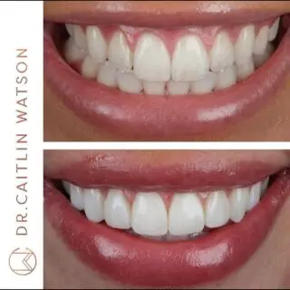 Composite bonding on 8 teeth to create a smile to be proud of ☺️

📩 send a DM for consultations 
💳 0% finance options available