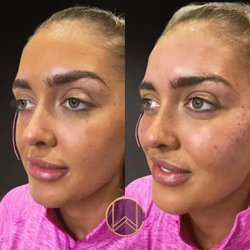 Cheek Enhancement