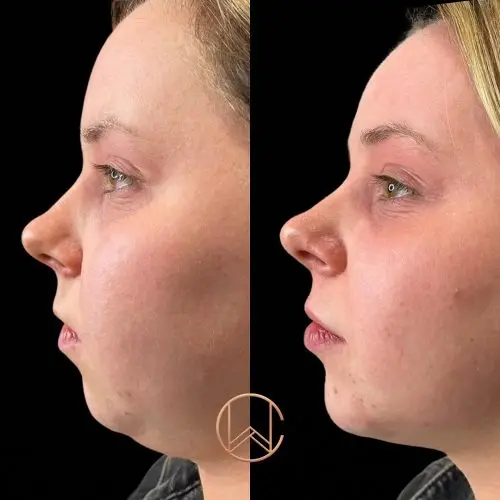 Chin Enhancement