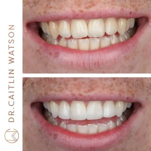 Whitening & Composite Bonding