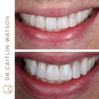 “It’s just a simple composite bonding case” 😱 

This patient had broken his front teeth on a lamppost a few years ago and came to see me for advice as to what I could do to improve the aesthetics. 

We decide on a plan of 8 teeth composite veneers once all the old work had been removed - all done in one appointment. 

Swipe to see how big of a knock these teeth had taken 🤕 >>>> 

Treatment: 
3 weeks of at home whitening 
8 teeth composite veneers