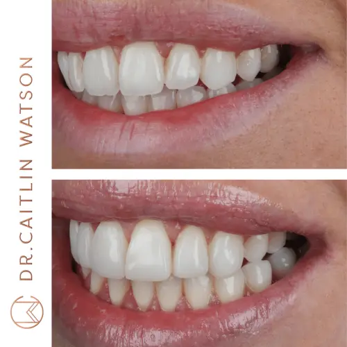 Whitening & Composite Bonding