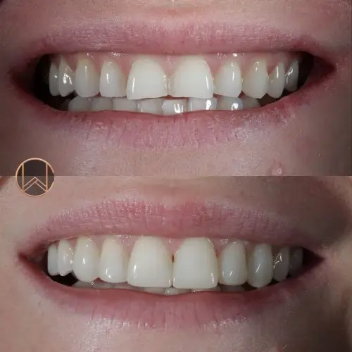 Composite Bonding
