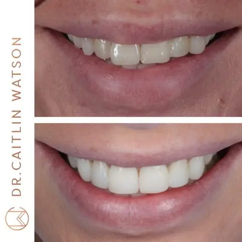 Invisalign & Composite Bonding