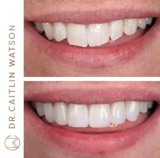 What a case to round off the first half of 2023! 

8 teeth composite veneers for this patient to create the smile he has always wanted. 

I’ve been working so hard in the last 6 months to refine my skills and give even better results to you all. 
June also marks a year since @mhairimcleann joined me in surgery and it’s been a real treat. Thanks for always keeping it zen and doing everything for me🧘🏼‍♀️

Let’s smash these next 6 months! 

📩 send a DM for consultations 
💳 0% finance options available