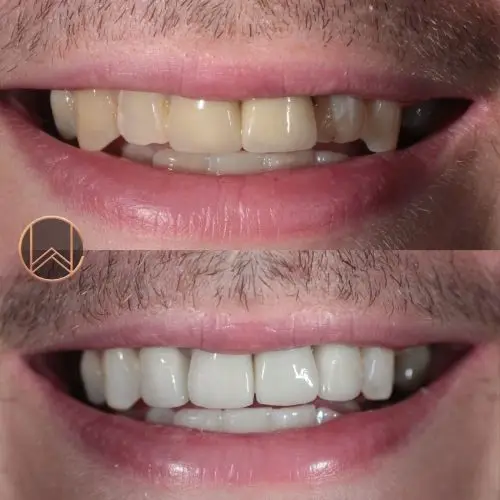 Porcelain Veneers & Crowns