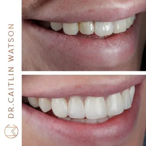 Invisalign and Composite Bonding