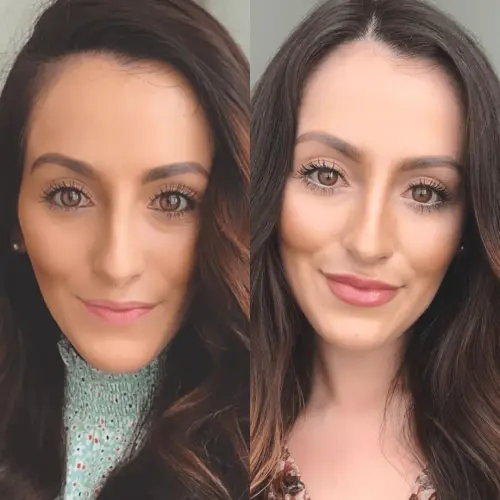 Lip & Cheek Filler